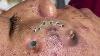 Big Cystic Acne Blackheads Extraction Blackheads U0026 Milia Whiteheads Suppression Du Bouton Popping 090